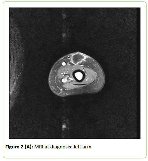 mycology-MRI-diagnosis