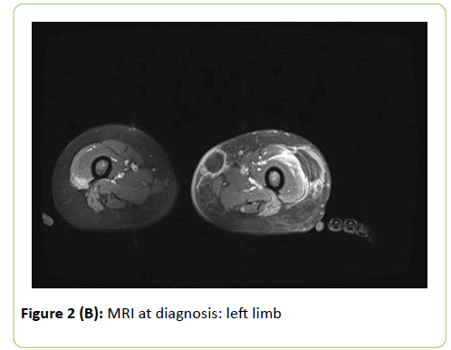 mycology-diagnosi-left-limb