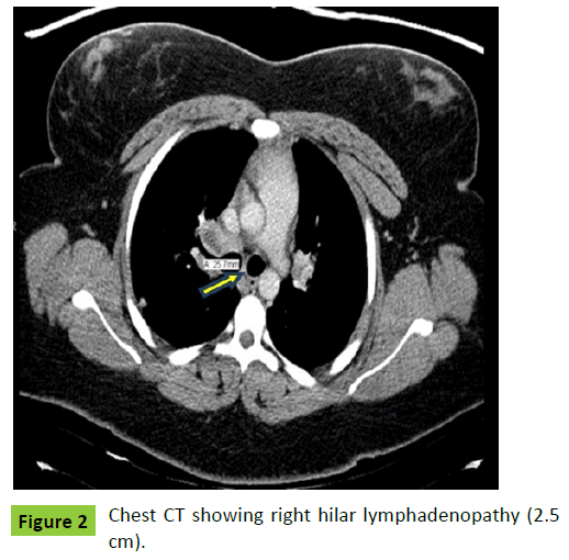 mycology-right-hilar-lymphadenopathy